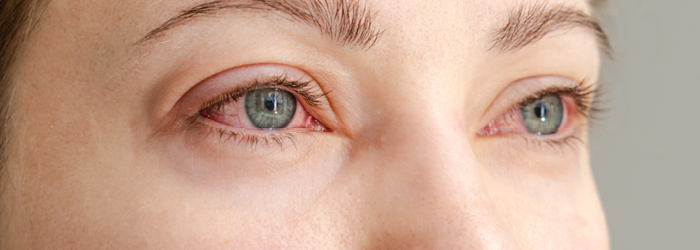 Common reasons you have red eyes