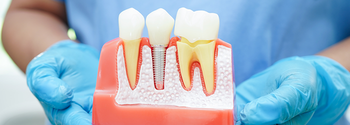 what are dental implants